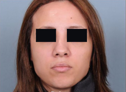 Rhinoplasty Before & After Patient #4446