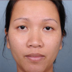 Rhinoplasty Before & After Patient #4444