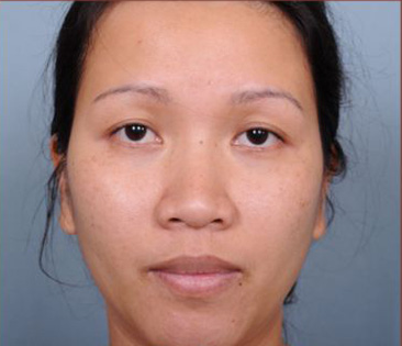 Rhinoplasty Before & After Patient #4444
