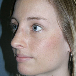 Rhinoplasty Before & After Patient #4447