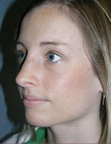 Rhinoplasty Before & After Patient #4447