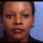 Rhinoplasty Before & After Patient #4445