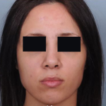 Rhinoplasty Before & After Patient #4446