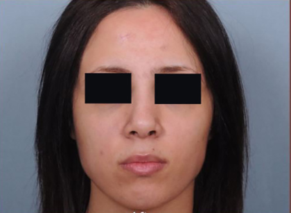 Rhinoplasty Before & After Patient #4446