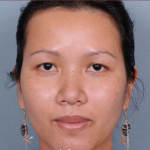 Rhinoplasty Before & After Patient #4444
