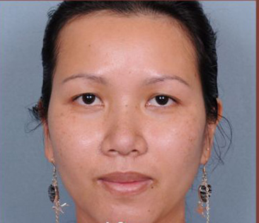 Rhinoplasty Before & After Patient #4444