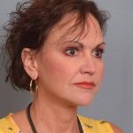 Facelift Before & After Patient #3599