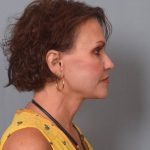 Facelift Before & After Patient #3599