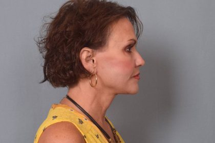 Facelift Before & After Patient #3599