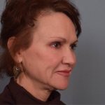 Facelift Before & After Patient #3599