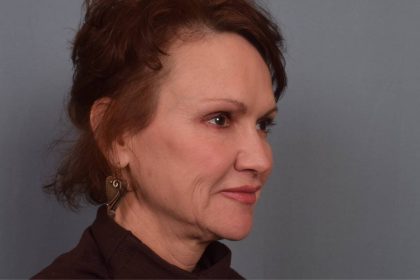 Facelift Before & After Patient #3599