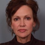 Facelift Before & After Patient #3599