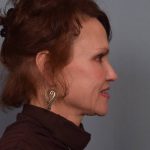 Facelift Before & After Patient #3599