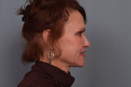 Facelift Before & After Patient #3599