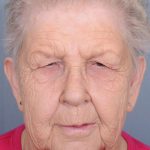 Blepharoplasty Before & After Patient #3582
