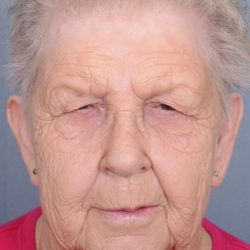 Blepharoplasty Before & After Patient #3582