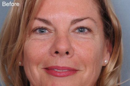 Blepharoplasty Before & After Patient #3585