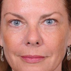 Blepharoplasty Before & After Patient #3585