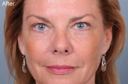Blepharoplasty Before & After Patient #3585