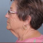 Neck Lift Before & After Patient #3698