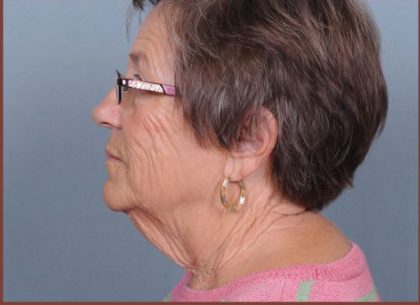 Neck Lift Before & After Patient #3698