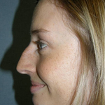 Rhinoplasty Before & After Patient #4447