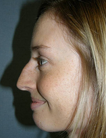 Rhinoplasty Before & After Patient #4447