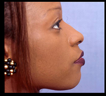Rhinoplasty Before & After Patient #4445
