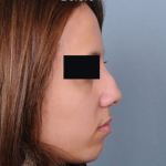 Rhinoplasty Before & After Patient #4446