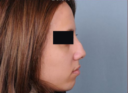 Rhinoplasty Before & After Patient #4446