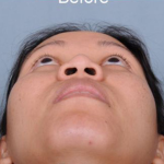 Rhinoplasty Before & After Patient #4444