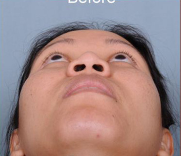 Rhinoplasty Before & After Patient #4444