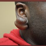 Earlobe Repair Before & After Patient #3720