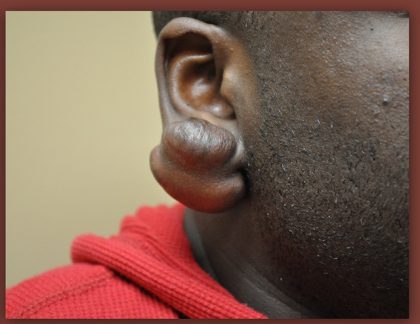 Earlobe Repair Before & After Patient #3720
