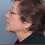 Neck Lift Before & After Patient #3698