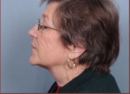 Neck Lift Before & After Patient #3698