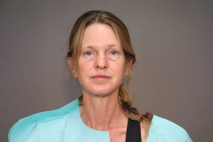 Blepharoplasty Before & After Patient #4539