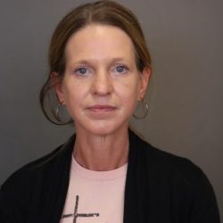 Blepharoplasty Before & After Patient #4539