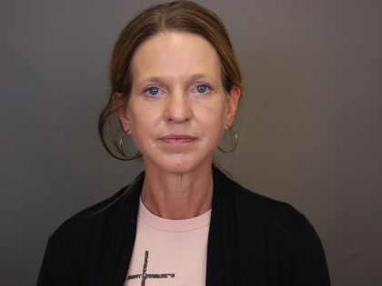 Blepharoplasty Before & After Patient #4539