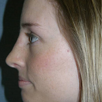 Rhinoplasty Before & After Patient #4447