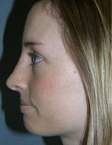 Rhinoplasty Before & After Patient #4447