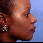 Rhinoplasty Before & After Patient #4445