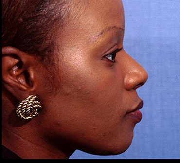 Rhinoplasty Before & After Patient #4445