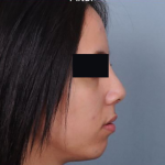 Rhinoplasty Before & After Patient #4446