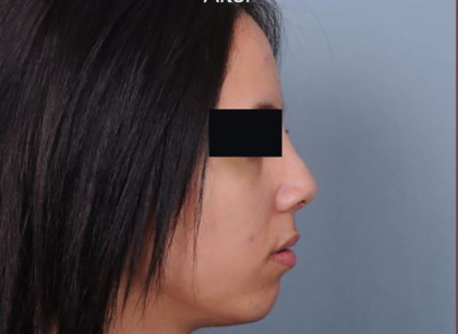Rhinoplasty Before & After Patient #4446