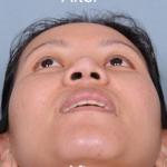 Rhinoplasty Before & After Patient #4444