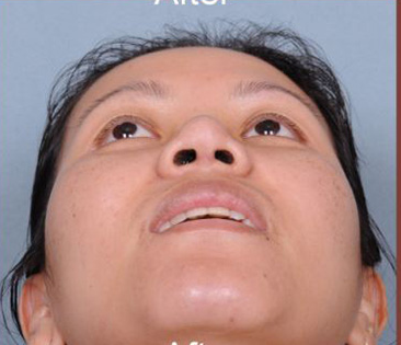 Rhinoplasty Before & After Patient #4444