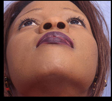 Rhinoplasty Before & After Patient #4445