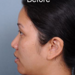 Rhinoplasty Before & After Patient #4444