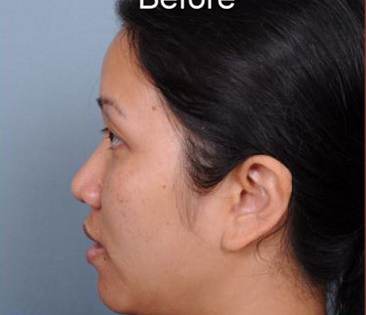 Rhinoplasty Before & After Patient #4444